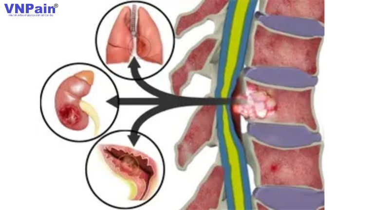 Ung thư di căn cột sống