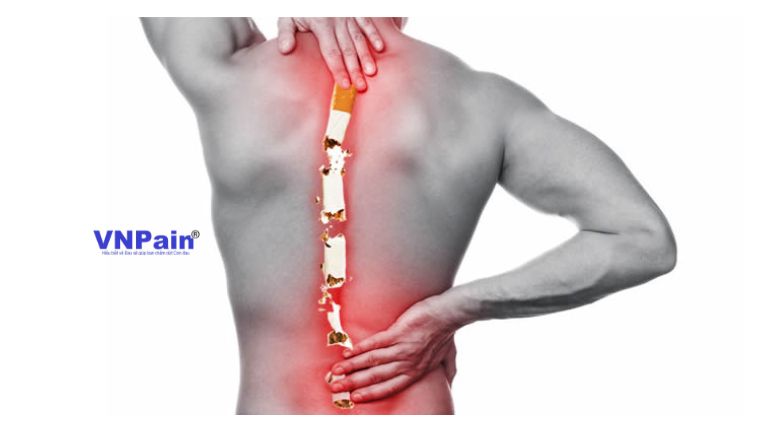 Hút thuốc có phải là nguyên nhân gây đau lưng không?