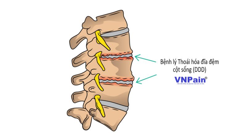 Thoái hóa đĩa đệm