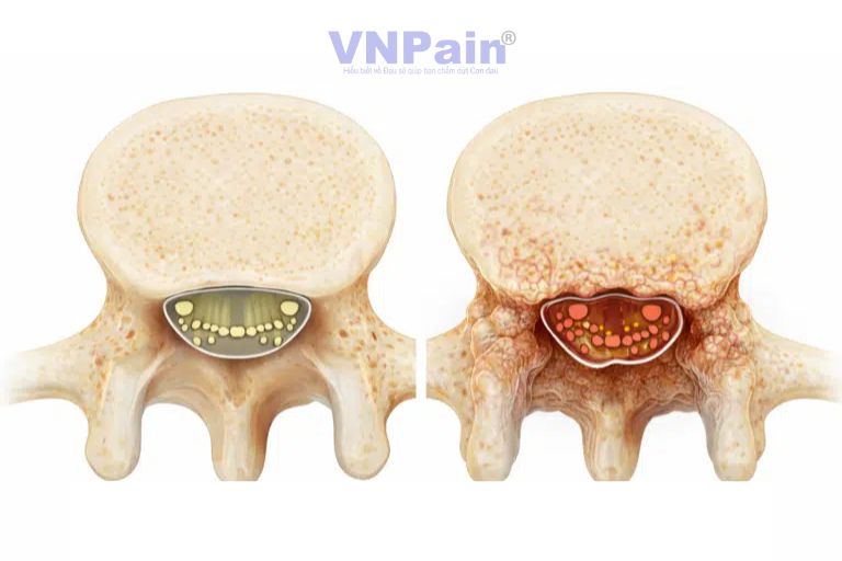 Hẹp ống sống cột sống thắt lưng