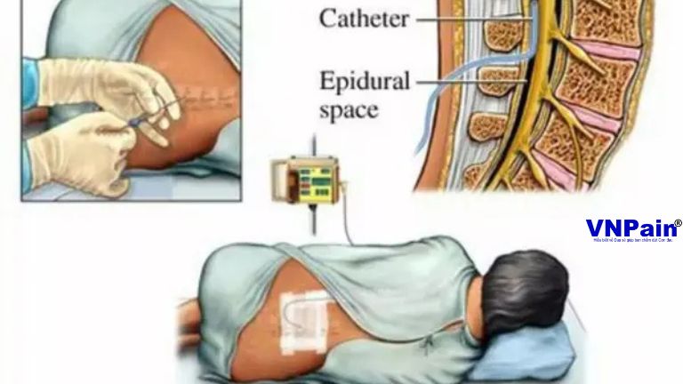 Điều trị giảm đau bằng thuốc