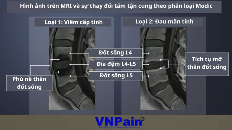 Hủy thần kinh trong thân đốt sống điều trị đau thắt lưng