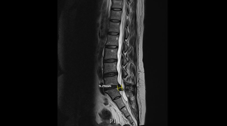 Khi nào cần chụp MRI cột sống?