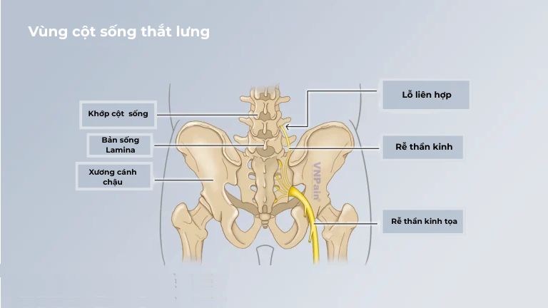hẹp ống sống