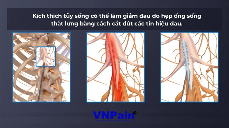 hẹp ống sống