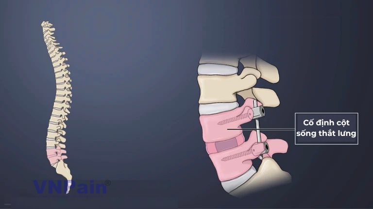 vẹo cột sống