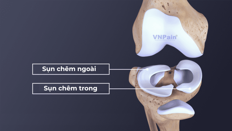 rách sụn chêm