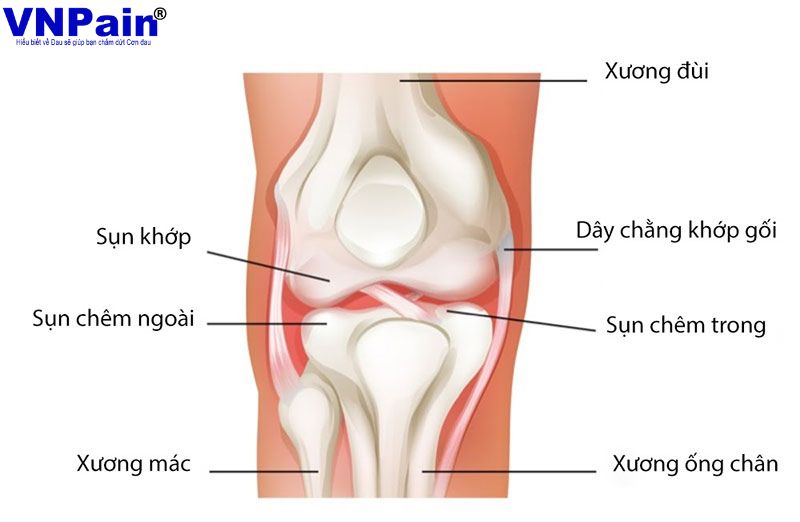 rách sụn chêm