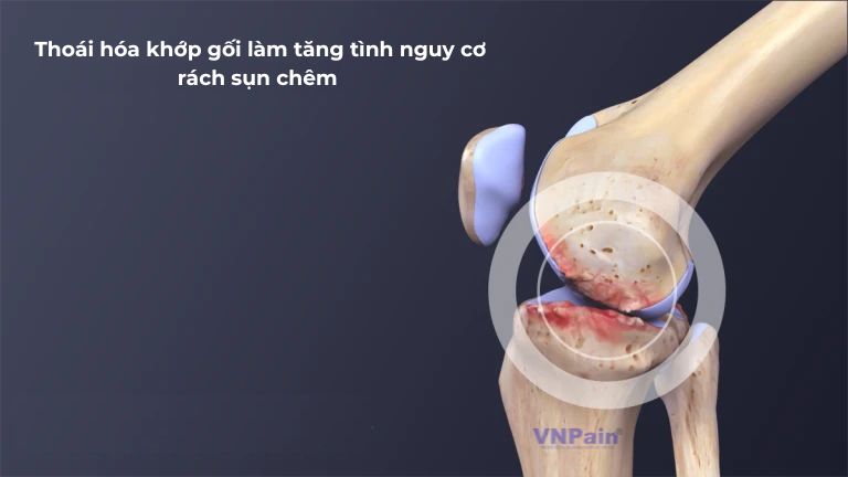 Rách sụn chêm