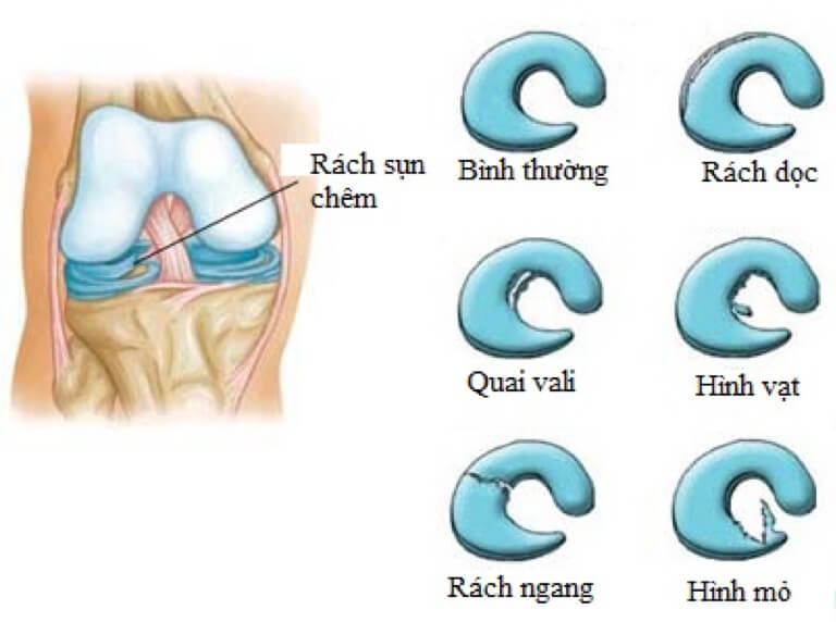 Chẩn đoán rách sụn chêm