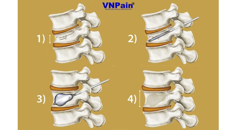 Gãy lún xẹp thân đốt sống