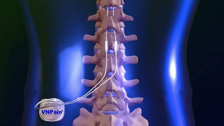 phẫu thuật cột sống thắt lưng
