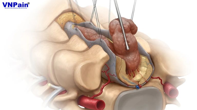 phẫu thuật cột sống thắt lưng
