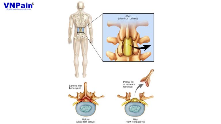 phẫu thuật cột sống thắt lưng