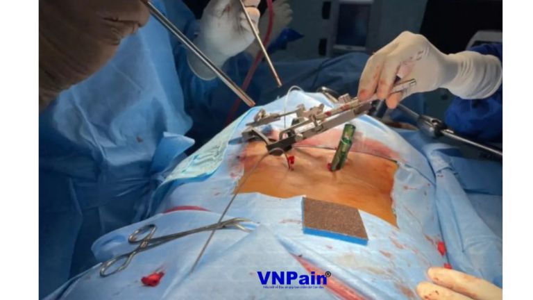 Những kết quả đáng mong đợi từ phẫu thuật cột sống