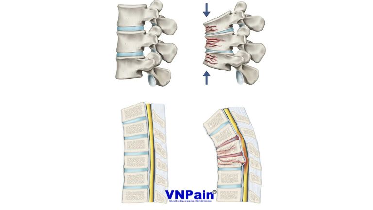 Gãy lún xẹp thân đốt sống