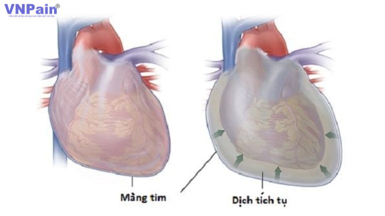 Đau lưng ngực