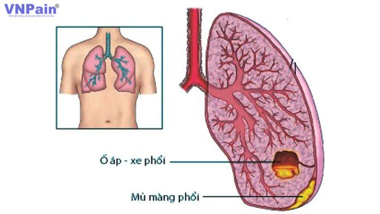 Đau lưng ngực