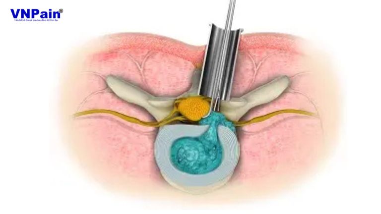 Phẫu thuật cột sống