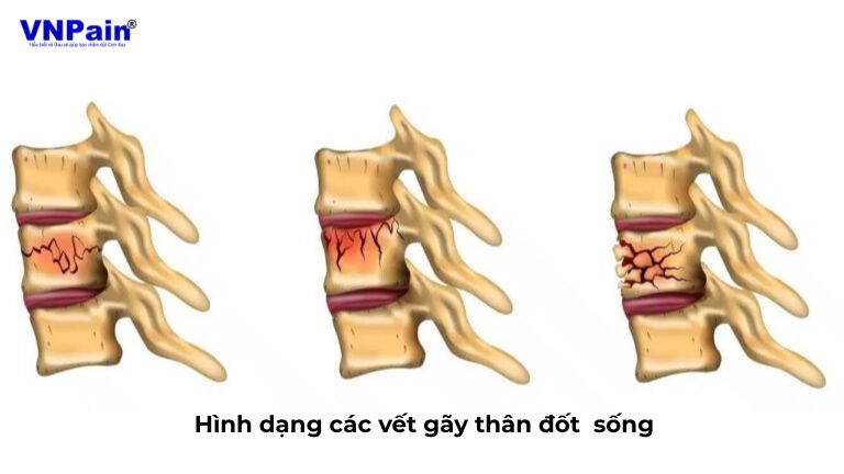 tạo hình đốt sống