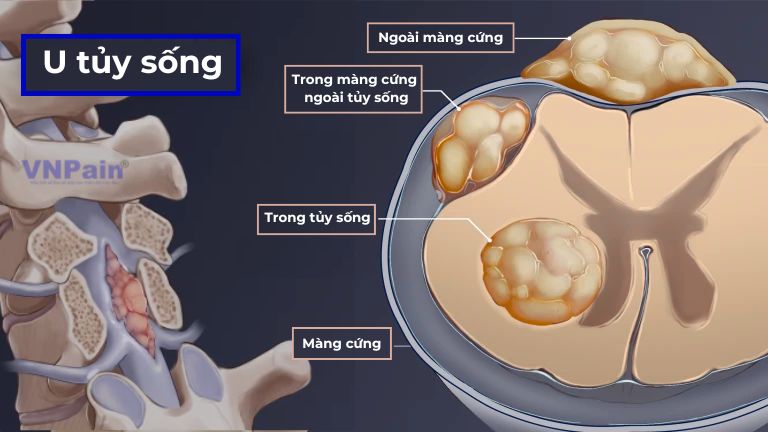 hẹp ống sống