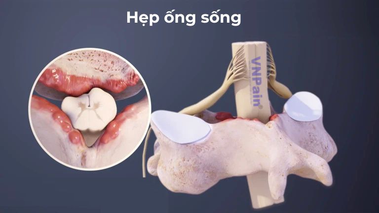 Hẹp ống sống