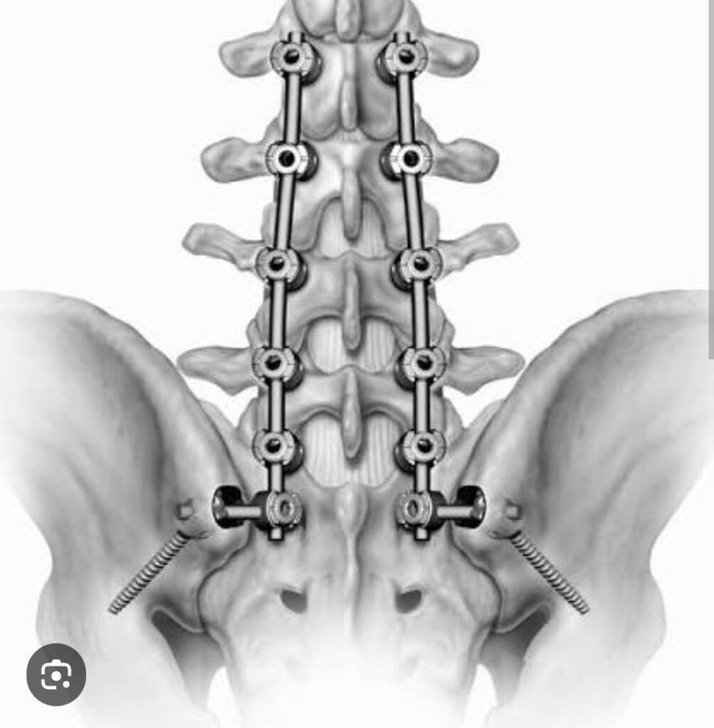 Vít chân cung trong phẫu thuật cố định cốt sống
