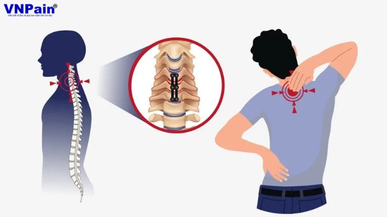 Tầm vận động cột sống cổ sau phẫu thuật cố định đa tầng