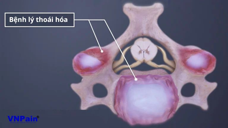 Tầm vận động cột sống cổ sau phẫu thuật cố định một tầng