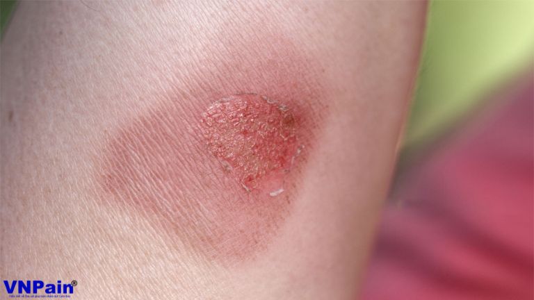 Rủi ro tiềm ẩn và chống chỉ định của liệu pháp nhiệt