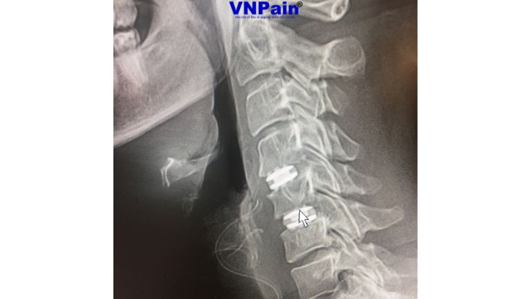 Tầm vận động của cổ bị hạn chế ra sao sau phẫu thuật cố định cột sống?