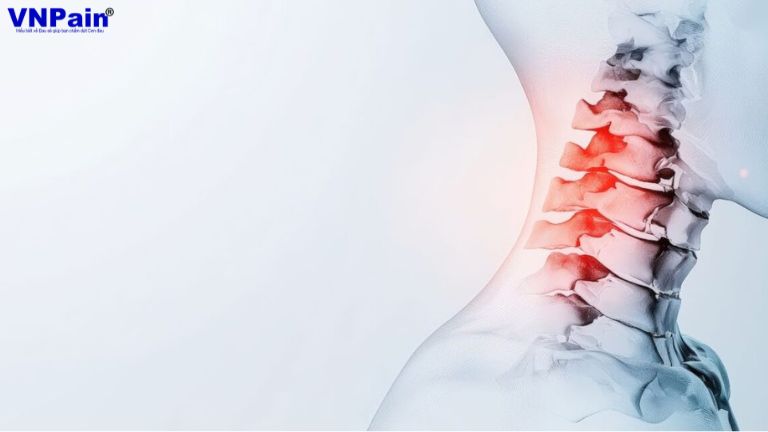 Tầm vận động cột sống cổ sau phẫu thuật cố định một tầng