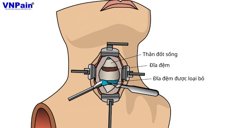 Tầm vận động cột sống cổ sau phẫu thuật cố định một tầng