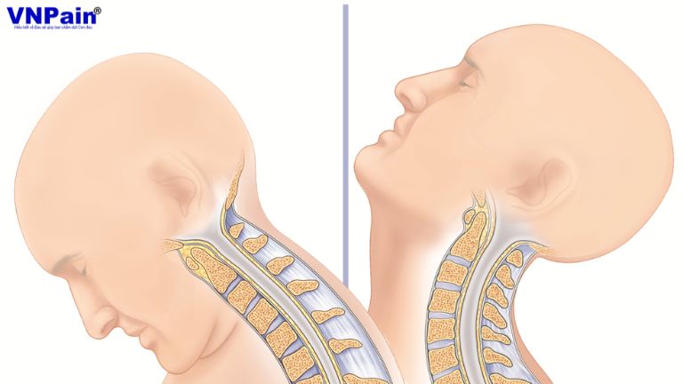 Tầm vận động của cổ bị hạn chế ra sao sau phẫu thuật cố định cột sống?