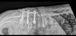 Vít chân cung trong phẫu thuật cố định cốt sống